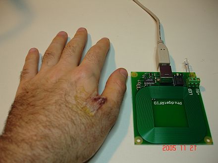 Human Implanted RFID Tag Human Implanted RFID Tag